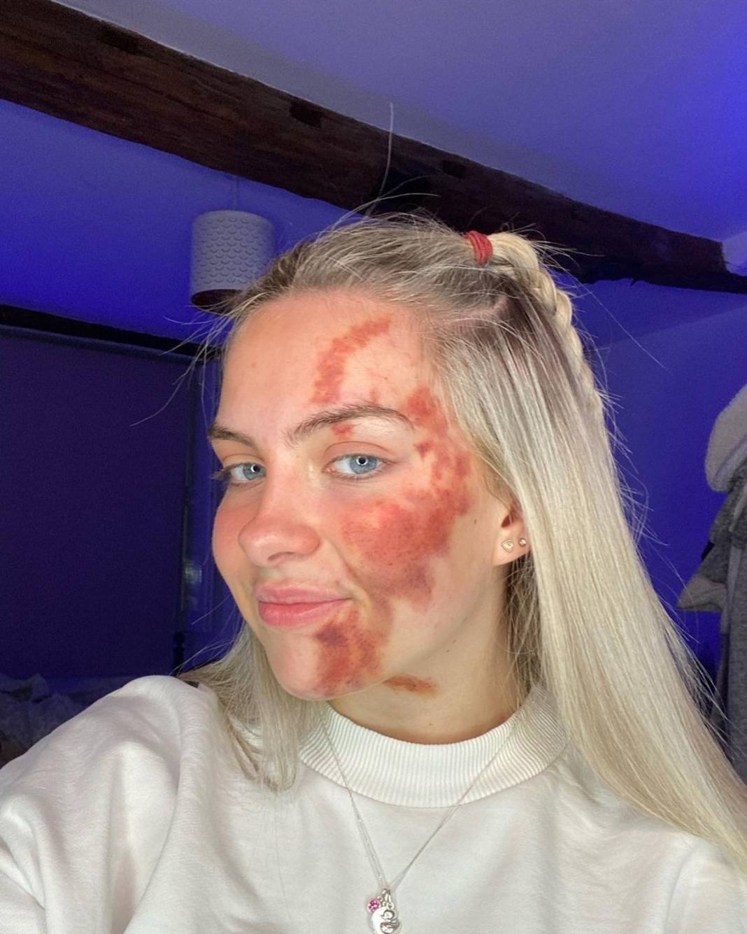 Basit bir uçuk zannetti, korkunç hastalığa yakalandı! Doktorlar bile teşhis koyamadı 12